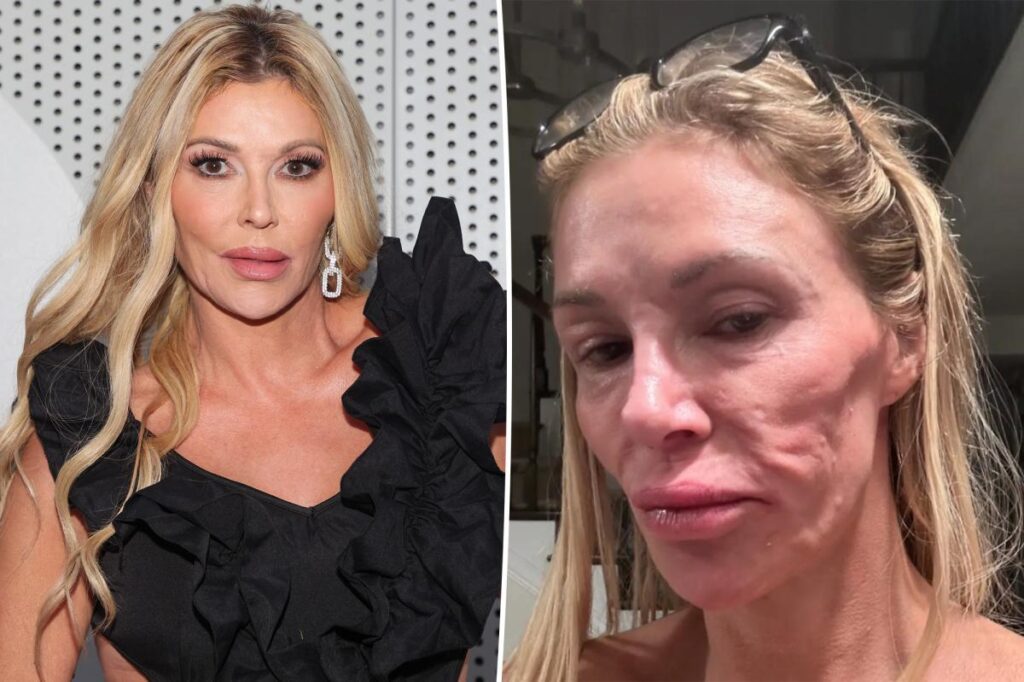 Brandi Glanville shares new health update after grueling battle with her facial disfigurement