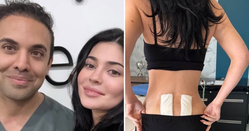 Kylie Jenner Opens Up About Undergoing Stem Cell Therapy After Pregnancy Left Her With ‘Chronic Back Pain’