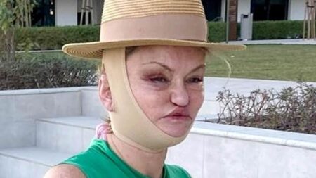 Danniella Westbrook remains bandaged and bruised in the wake of her facial reconstruction surgery as she continues her recovery in Dubai