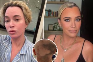 Teddi Mellencamp showcases brain surgery scars amid cancer battle