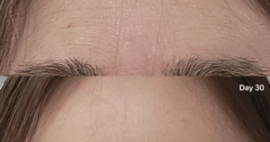 Wrinkles Between Your Eyebrows? This 3-Minute Treatment Can Make You Look 10 Years Younger