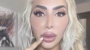 Farrah Abraham now unable to fully open her mouth… after spending almost $1million on cosmetic surgery