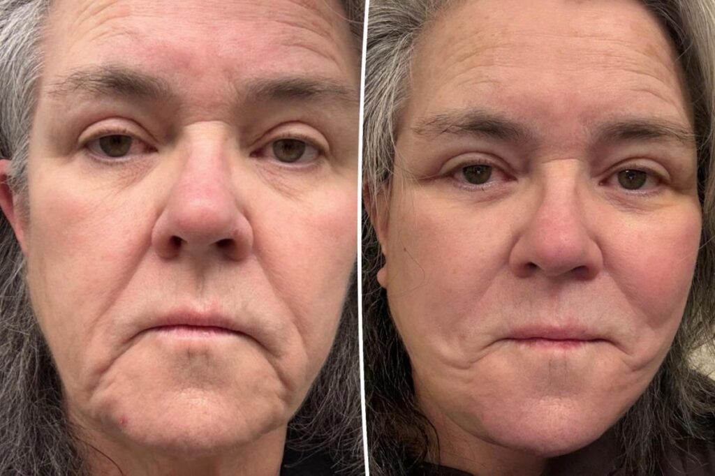 Rosie O’Donnell shares before-and-after photos of facelift