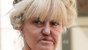Danniella Westbrook reveals her scars from facial reconstruction surgery as she heads to the hair salon