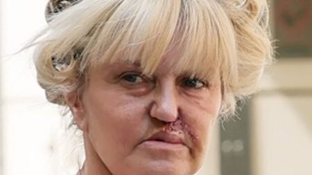 Danniella Westbrook reveals her scars from facial reconstruction surgery as she heads to the hair salon