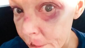 Gail Porter reveals black eye and bruised cut lip after she was knocked down the stairs at a London tube station as she urges keyboard warriors to be ‘kind to her’