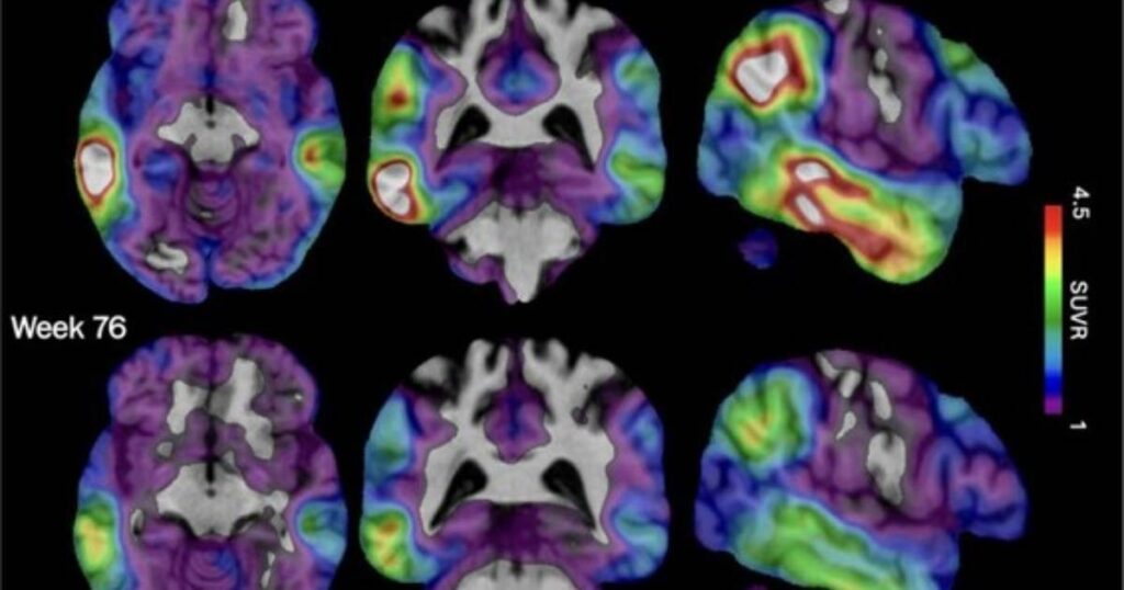 An experimental Alzheimer’s drug shows promise targeting a different brain protein, new study shows, Lifestyle News