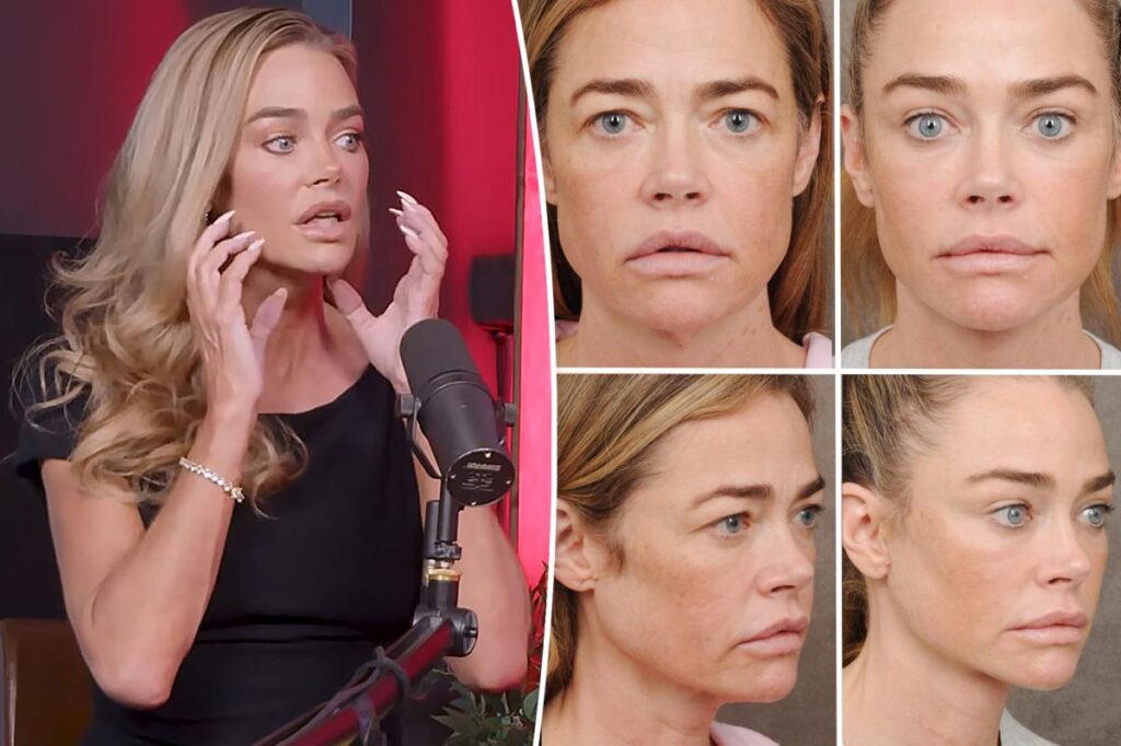 Denise Richards reveals new facelift details