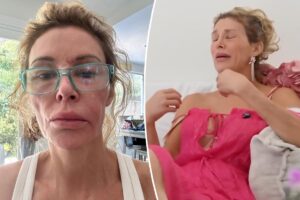 Brandi Glanville breaks down over GoFundMe as she faces ongoing facial disfigurement